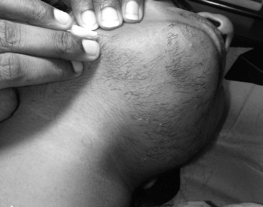 10 Ways To Treat Hirsutism and Facial Hair in Females 